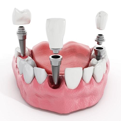 implant dentar preturi-min